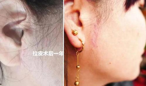 微创手术疤痕图片